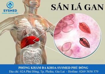 SÁN LÁ GAN: NGUYÊN NHÂN, TRIỆU CHỨNG VÀ PHƯƠNG PHÁP ĐIỀU TRỊ