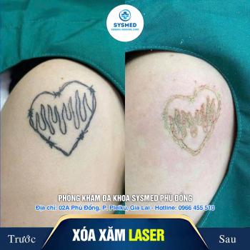 XÓA XĂM AN TOÀN BẰNG CÔNG NGHỆ LASER Q-SWITCH ND YAG - CHUẨN Y KHOA TẠI GIA LAI