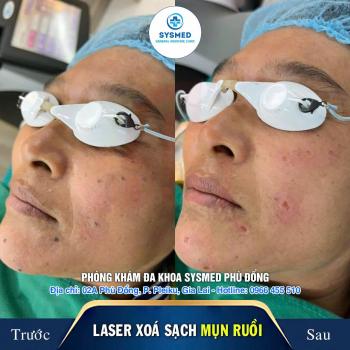 TẨY NỐT RUỒI – MỤN RUỒI AN TOÀN, CHUẨN Y KHOA TẠI GIA LAI