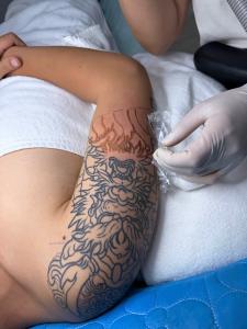 XÓA XĂM LASER YAG THẾ HỆ MỚI – AN TOÀN CHUẨN Y KHOA